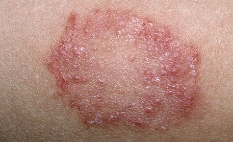 Fungal skin Diseases